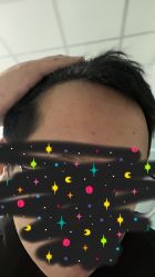 -大麦微针植发丨全国连锁