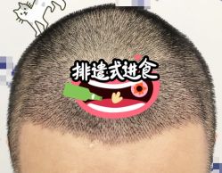 -大麦微针植发全国连锁