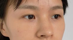 -广州健丽·去眼袋医疗美容机构