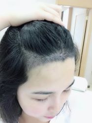 -大麦微针植发丨全国连锁