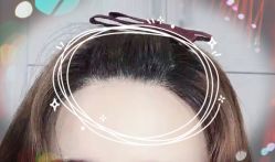 -大麦微针植发全国连锁