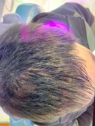 点击看大图 体验后-大麦微针植发丨全国连锁