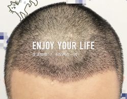 -大麦微针植发全国连锁