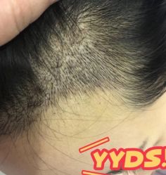 -大麦微针植发丨全国连锁