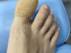 -祖传修脚甲沟炎灰指甲鸡眼