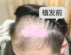 -大麦微针植发全国连锁