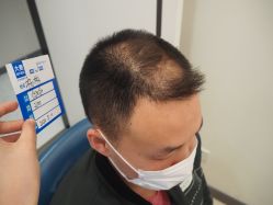 -大麦微针植发丨全国连锁