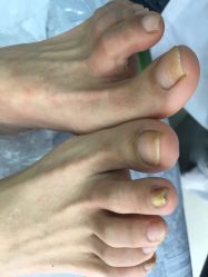 -德哥灰指甲脚气甲沟炎跖疣护理