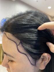-碧莲盛不剃发植发