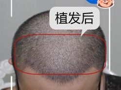 -大麦微针植发全国连锁