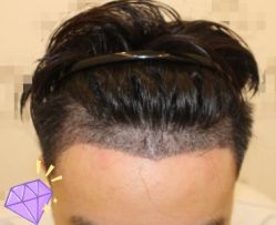 -大麦微针植发丨全国连锁