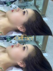 点击看大图 -OnFaer.纹眉半永久无创洗眉