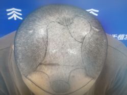 -雍禾植发全国连锁