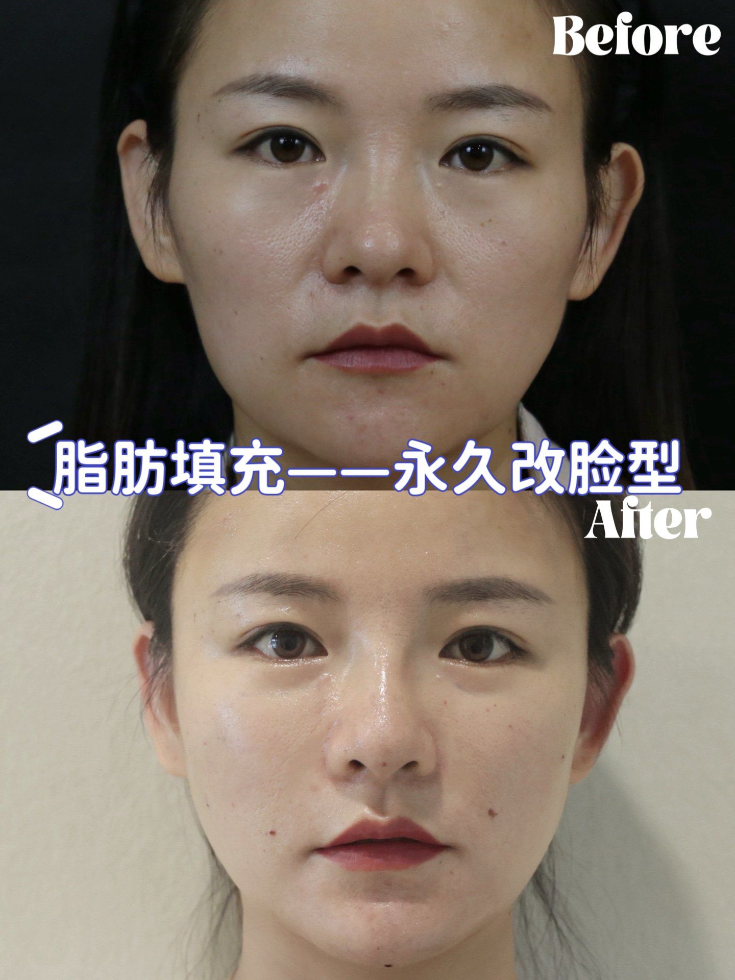 自体脂肪永久改脸型