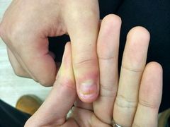 -Andrew指甲专科灰指甲·甲沟炎矫正·3D步态矫形鞋垫定制(上海法华镇路旗舰店)