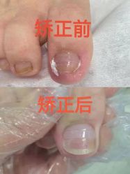 -德哥灰指甲脚气甲沟炎跖疣护理