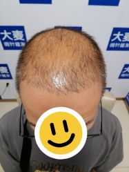 体验前-大麦微针植发丨全国连锁