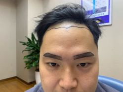 -大麦微针植发全国连锁