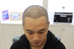 -大麦微针植发丨全国连锁