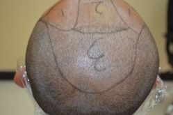 -大麦微针植发丨全国连锁