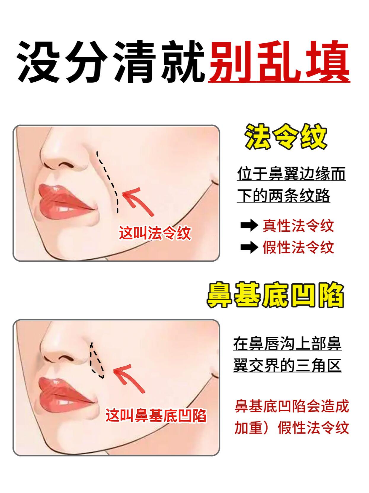 鼻基底和法令纹区别图图片