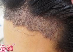 -大麦微针植发丨全国连锁