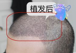 -大麦微针植发全国连锁