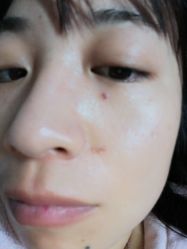体验后-成都西区医院整形美容