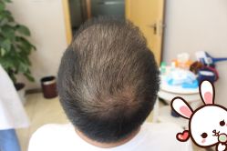 点击看大图 -大麦微针植发丨全国连锁