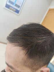 -大麦微针植发丨全国连锁