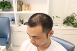 点击看大图 -大麦微针植发丨全国连锁