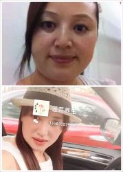 -莲芸拔罐减肥