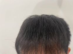 -碧莲盛·不剃发植发