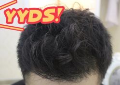 -大麦微针植发丨全国连锁