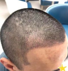 -大麦微针植发丨全国连锁