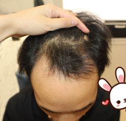 -大麦微针植发丨全国连锁