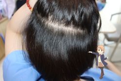 -大麦微针植发丨全国连锁