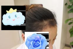 -大麦微针植发丨全国连锁