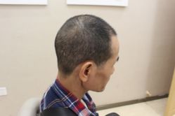 -大麦微针植发丨全国连锁