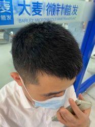体验后-大麦微针植发全国连锁