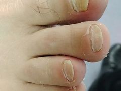 -祖传修脚甲沟炎灰指甲鸡眼