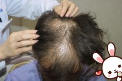 点击看大图 -大麦微针植发丨全国连锁