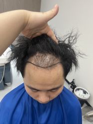 -大麦微针植发全国连锁