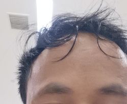 -碧莲盛·不剃发植发