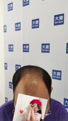 体验前-大麦微针植发全国连锁