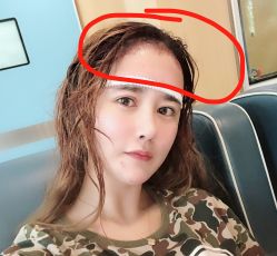 点击看大图 -大麦微针植发丨全国连锁