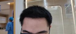 -大麦微针植发丨全国连锁