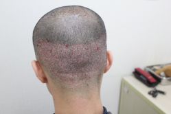 点击看大图 -大麦微针植发丨全国连锁