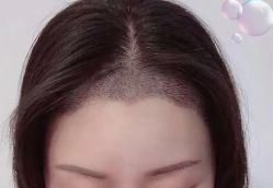 -大麦微针植发丨全国连锁