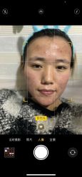 点击看大图 体验后-北京英煌医疗美容